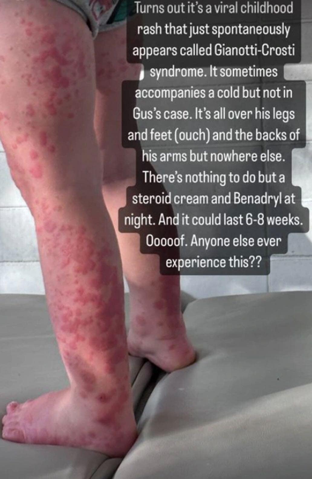 mandy moores ig photo of her son gus rash on his legs