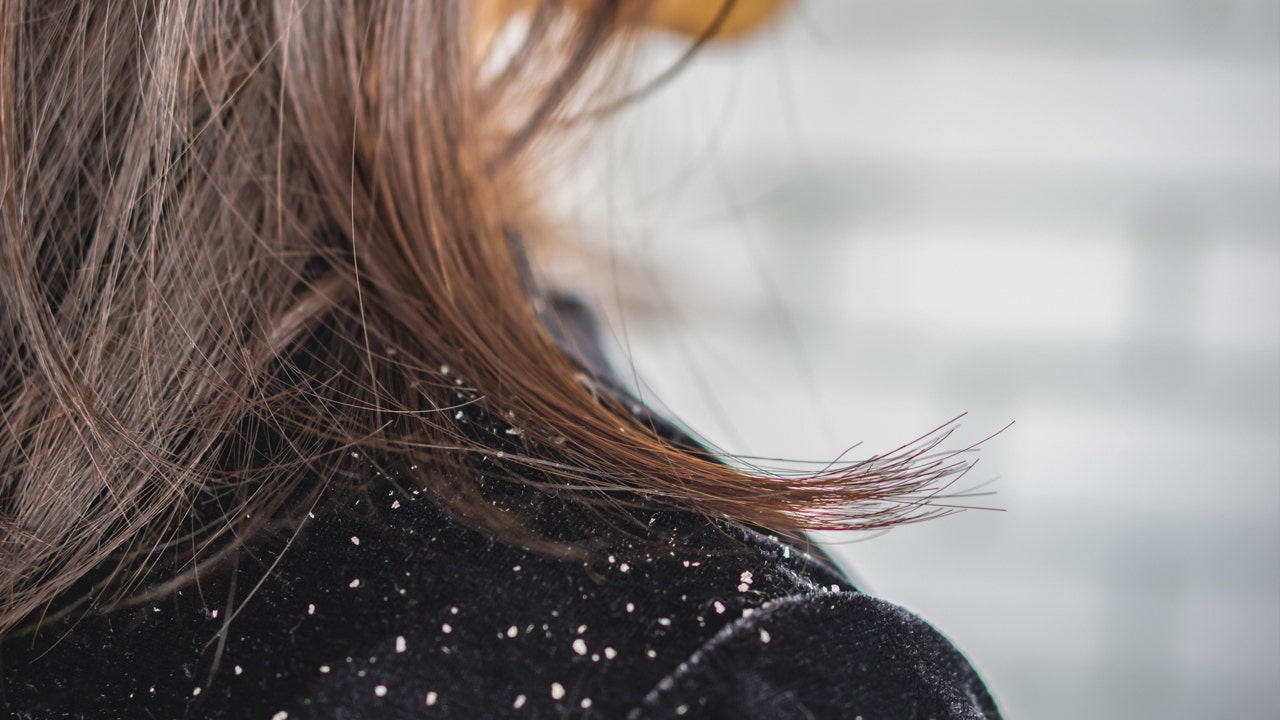 How to get rid of dandruff: Scalp experts share treatment tips and potential causes