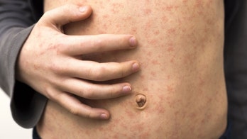 Measles protection is paramount before traveling outside the US, says CDC